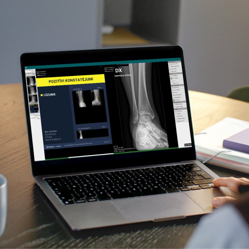 Rentgena diagnostikā izmanto mākslīgo intelektu